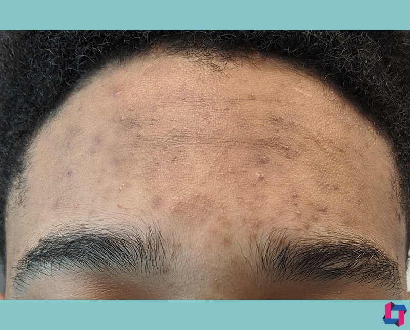 Aerolase Laser Treatment Before and After | Comprehensive Laser & Aesthetics
