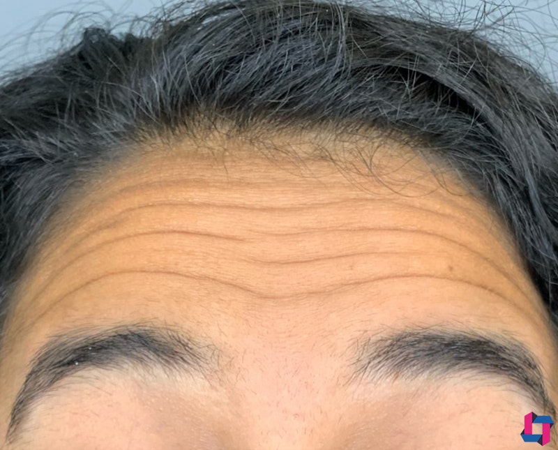 Botox Dysport Before and After | Comprehensive Laser & Aesthetics