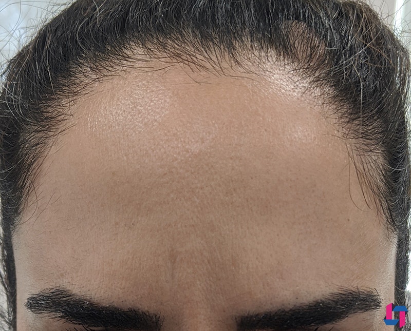 Botox Dysport Before and After | Comprehensive Laser & Aesthetics