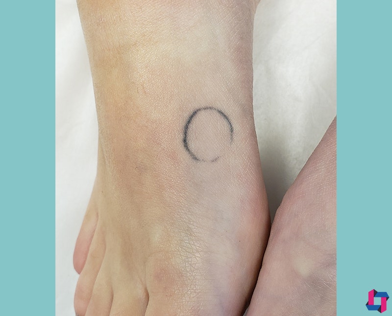 Laser Tattoo Removal Before and After | Comprehensive Laser & Aesthetics