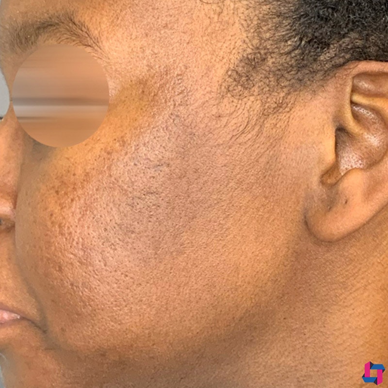 Microneedling Before and After | Comprehensive Laser & Aesthetics