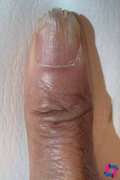 Nail Fungus Before and After | Comprehensive Laser & Aesthetics