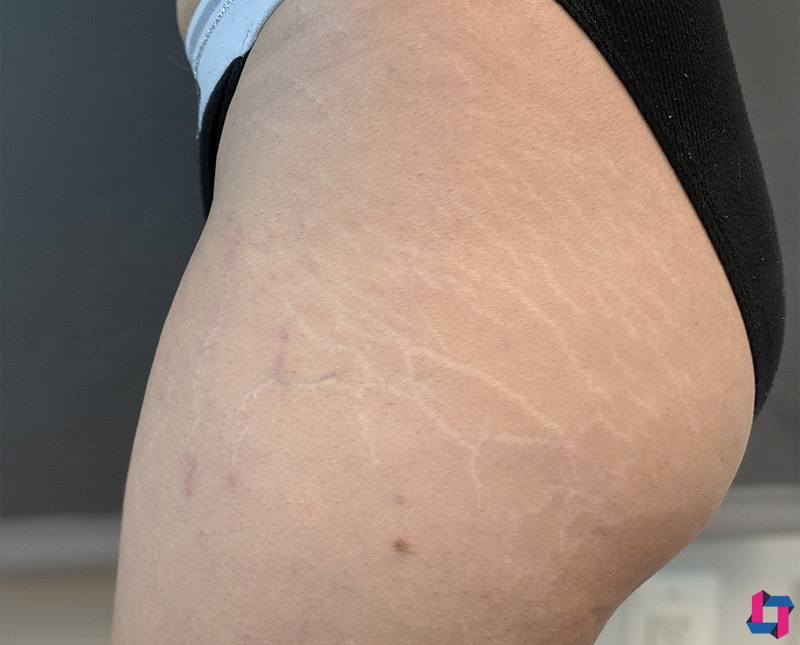 Stretch Marks Before and After | Comprehensive Laser & Aesthetics