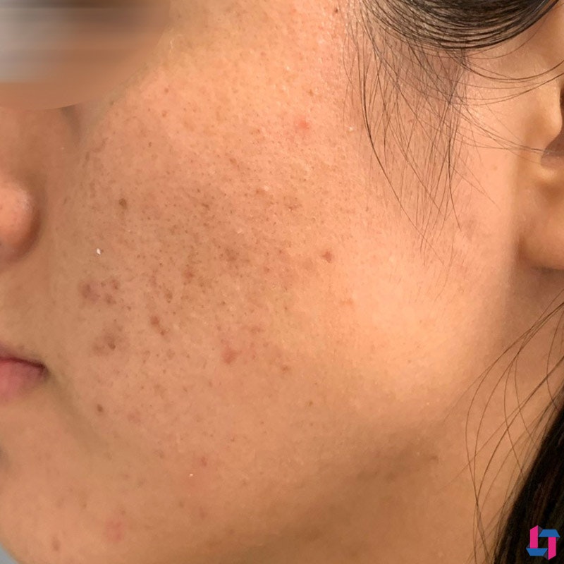 Vi Peel Before and After | Comprehensive Laser & Aesthetics